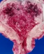 ENDOMETRIAL CARCINOMA 
