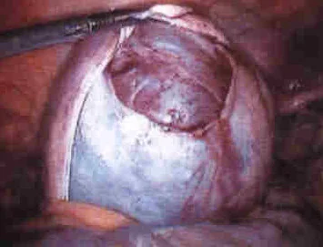 ENDOMETRIOMA