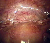 ENDOMETRIOSIS - BLADDER