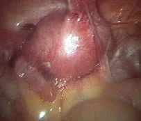 ENDOMETRIOSIS - CUL DE SAC