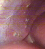 DIAPHRAGMATIC ENDOMETRIOSIS