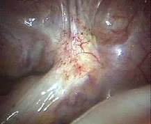 ENDOMETRIOSIS