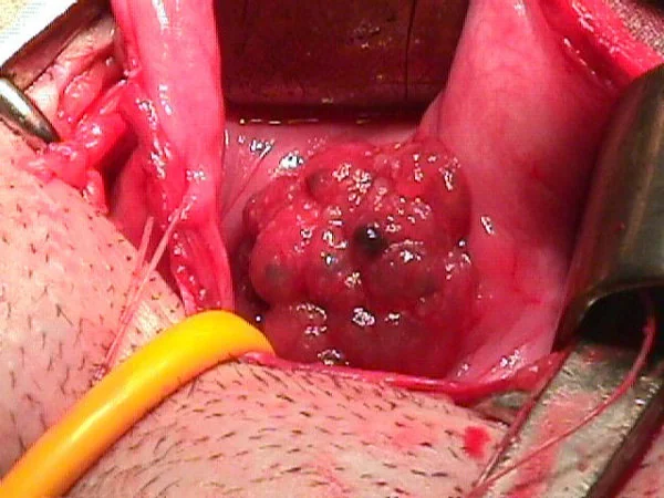 ENDOMETRIOSIS
