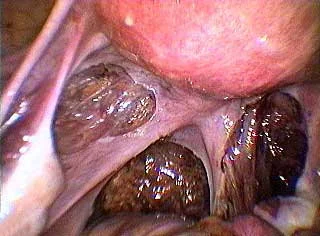 ENDOMETRIOSIS