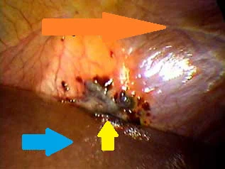 ENDOMETRIOSIS