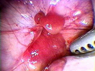 ENDOMETRIOSIS