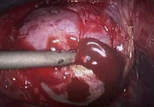 ENDOMETRIOSIS CHOCOLATE CYST