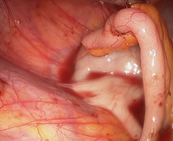 APPENDICULAR ENDOMETRIOSIS 