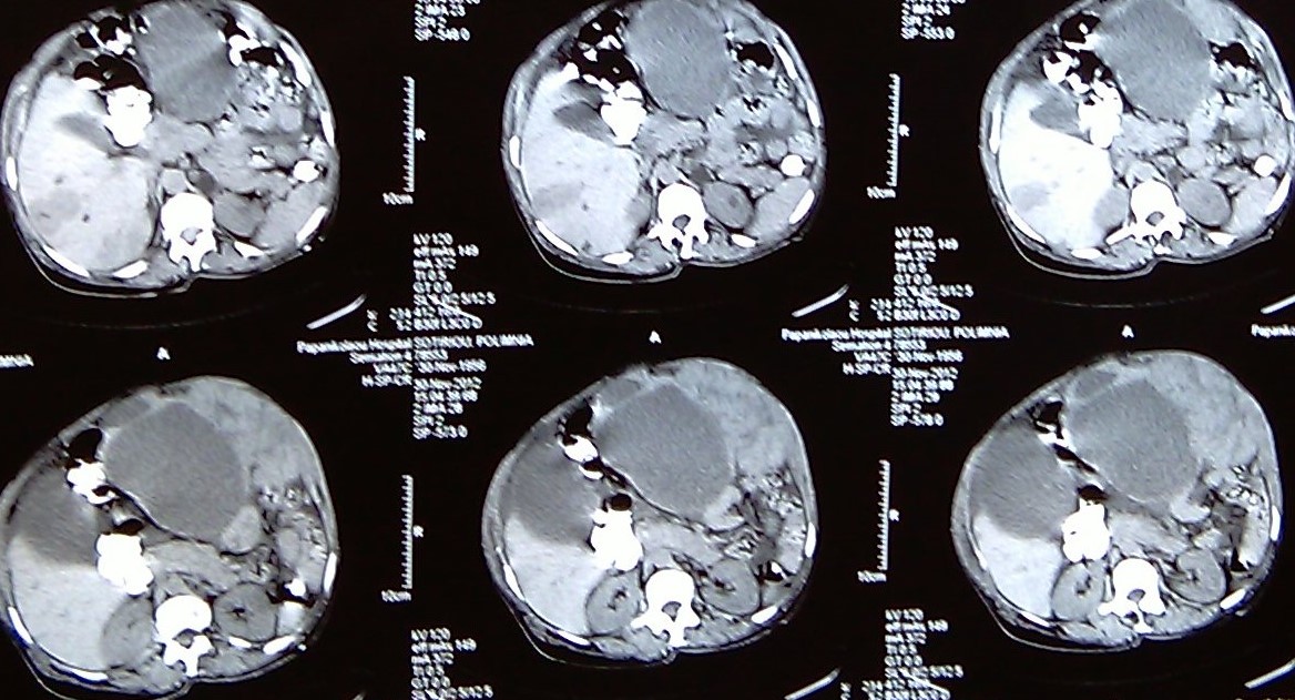 CYSTIC OVARIAN ADENOCARCINOMA