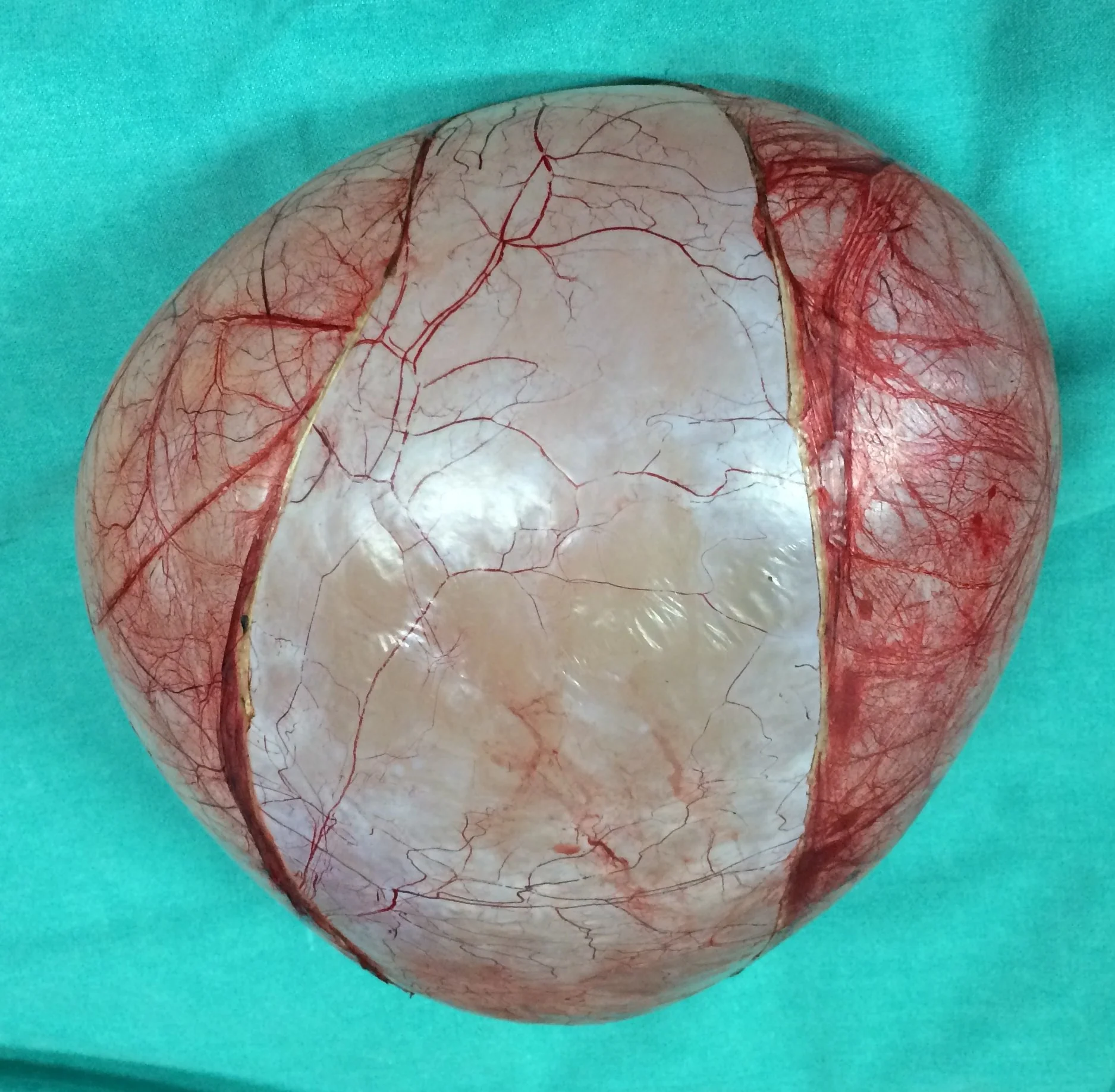 BENIGN OVARIAN CYSTADENOMA