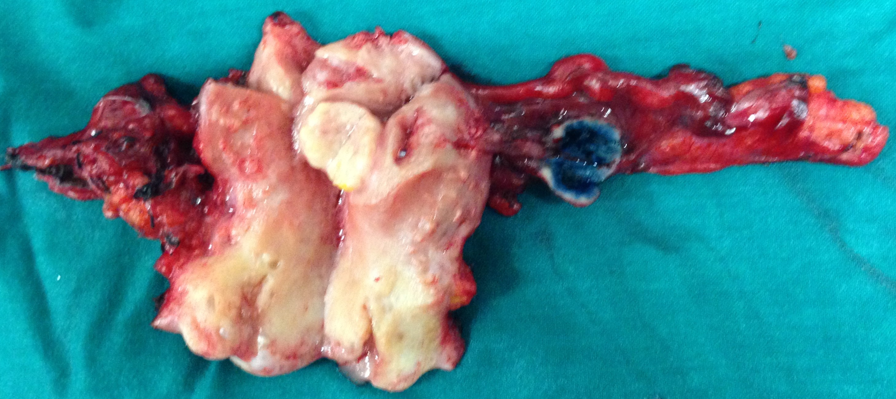 TOTAL HYSTERECTOMY
