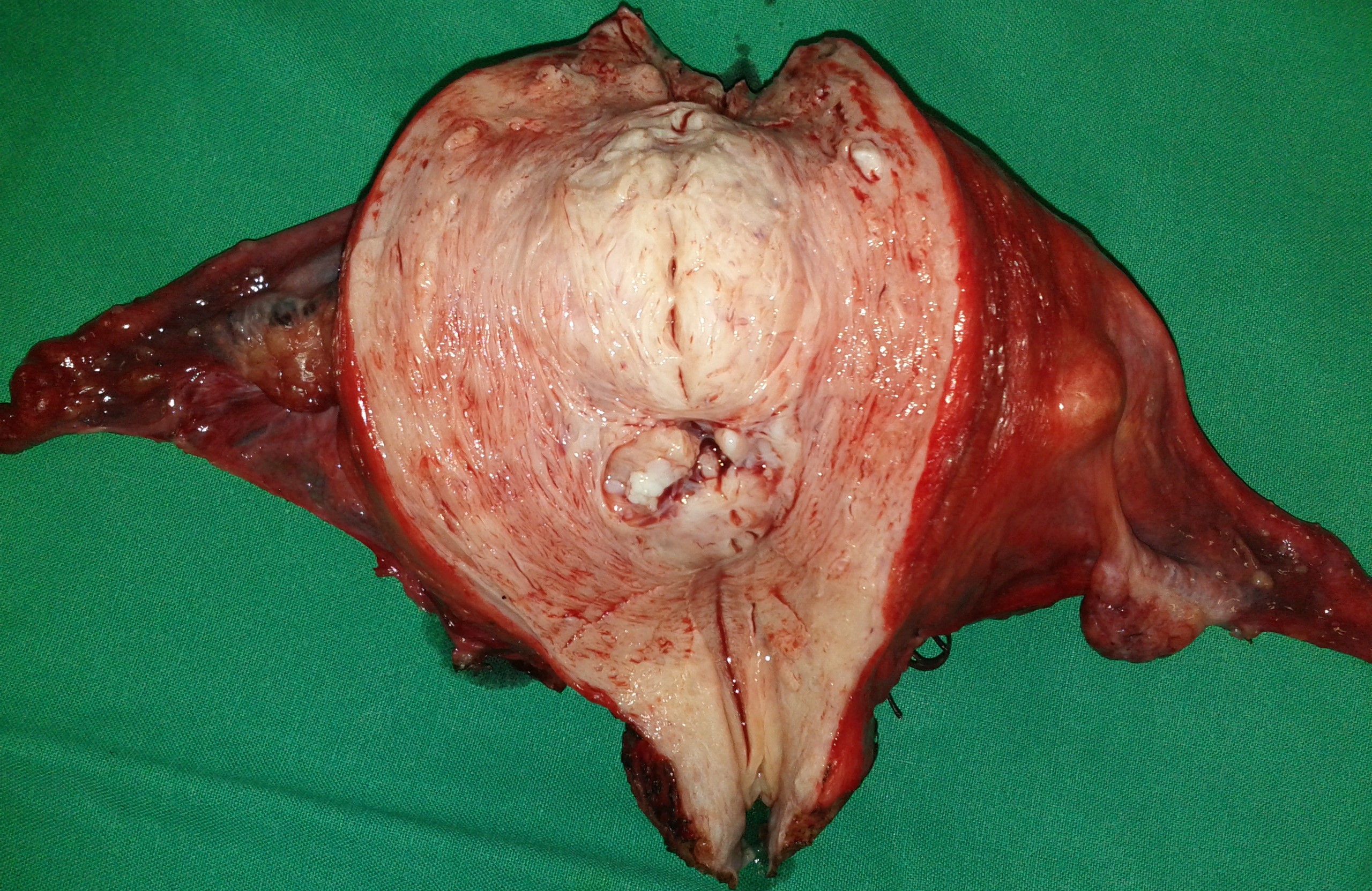 TOTAL HYSTERECTOMY
