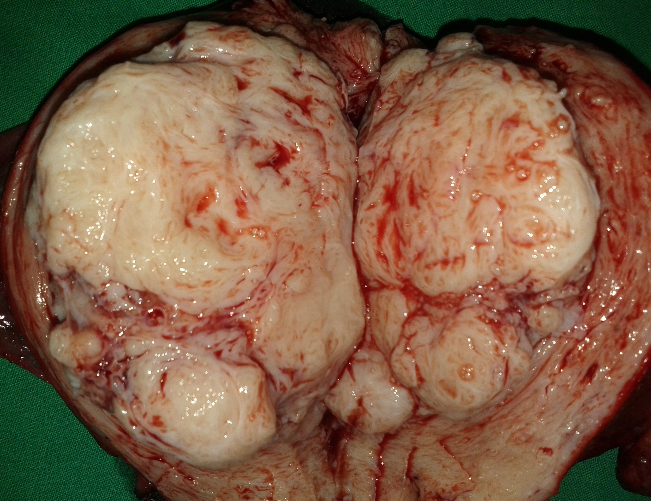 TOTAL HYSTERECTOMY - FIBROIDS