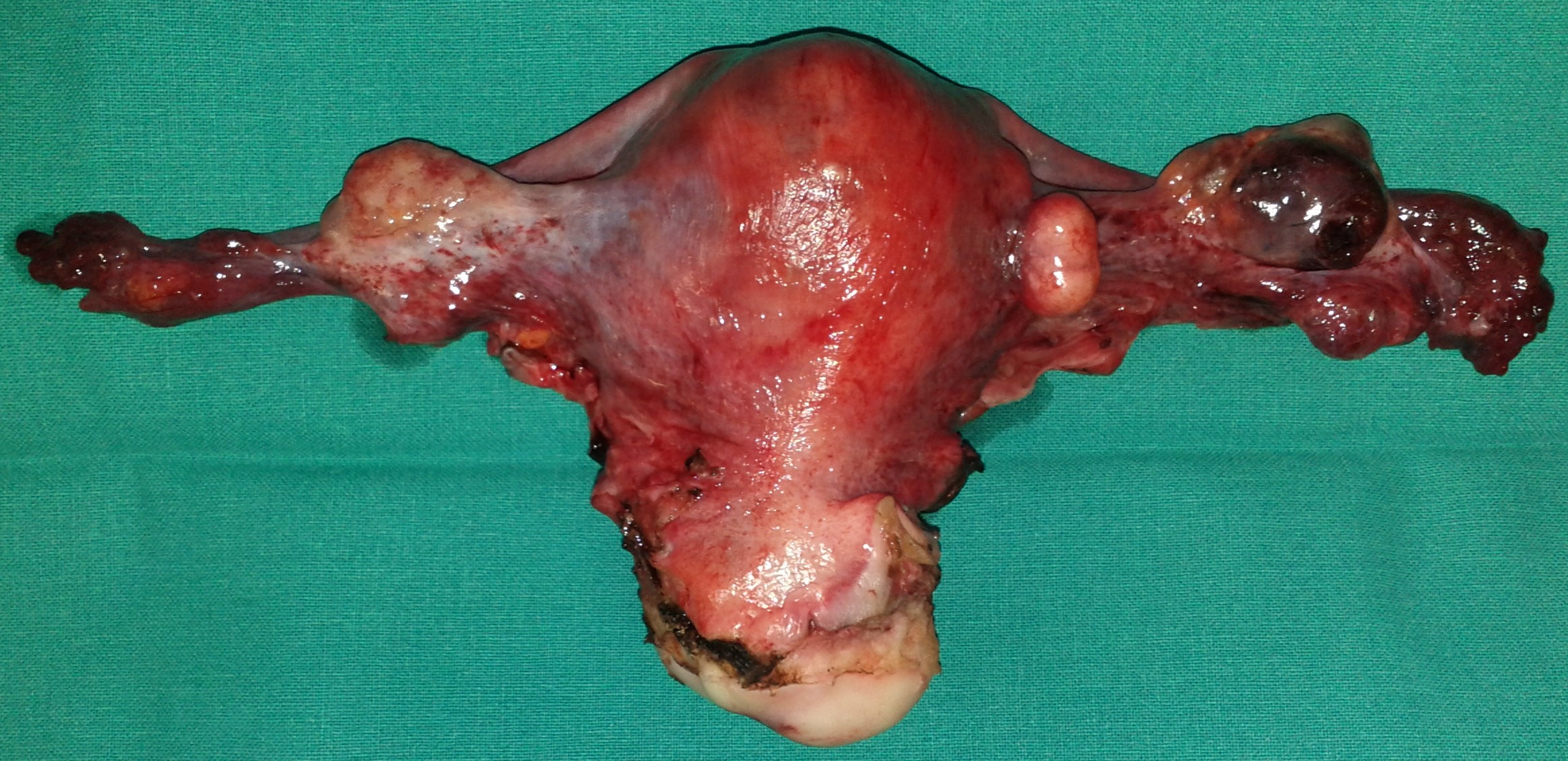 UTERINE CARCINOMA