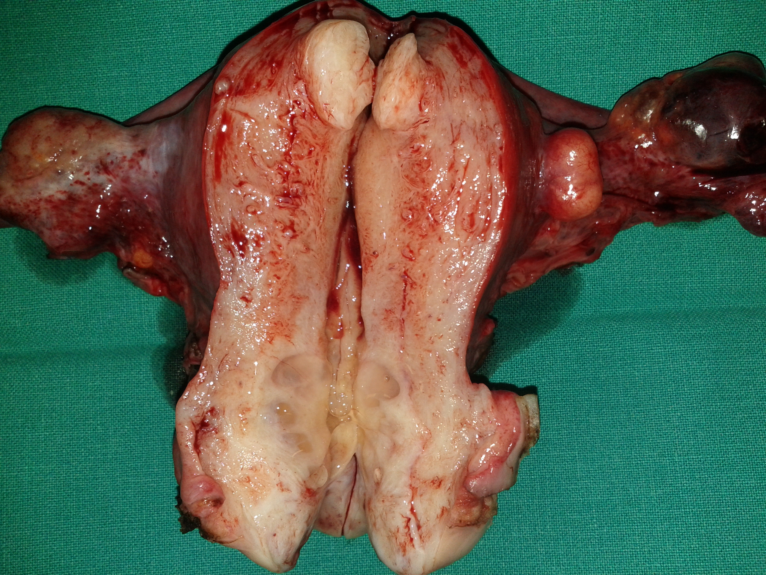 UTERINE CARCINOMA