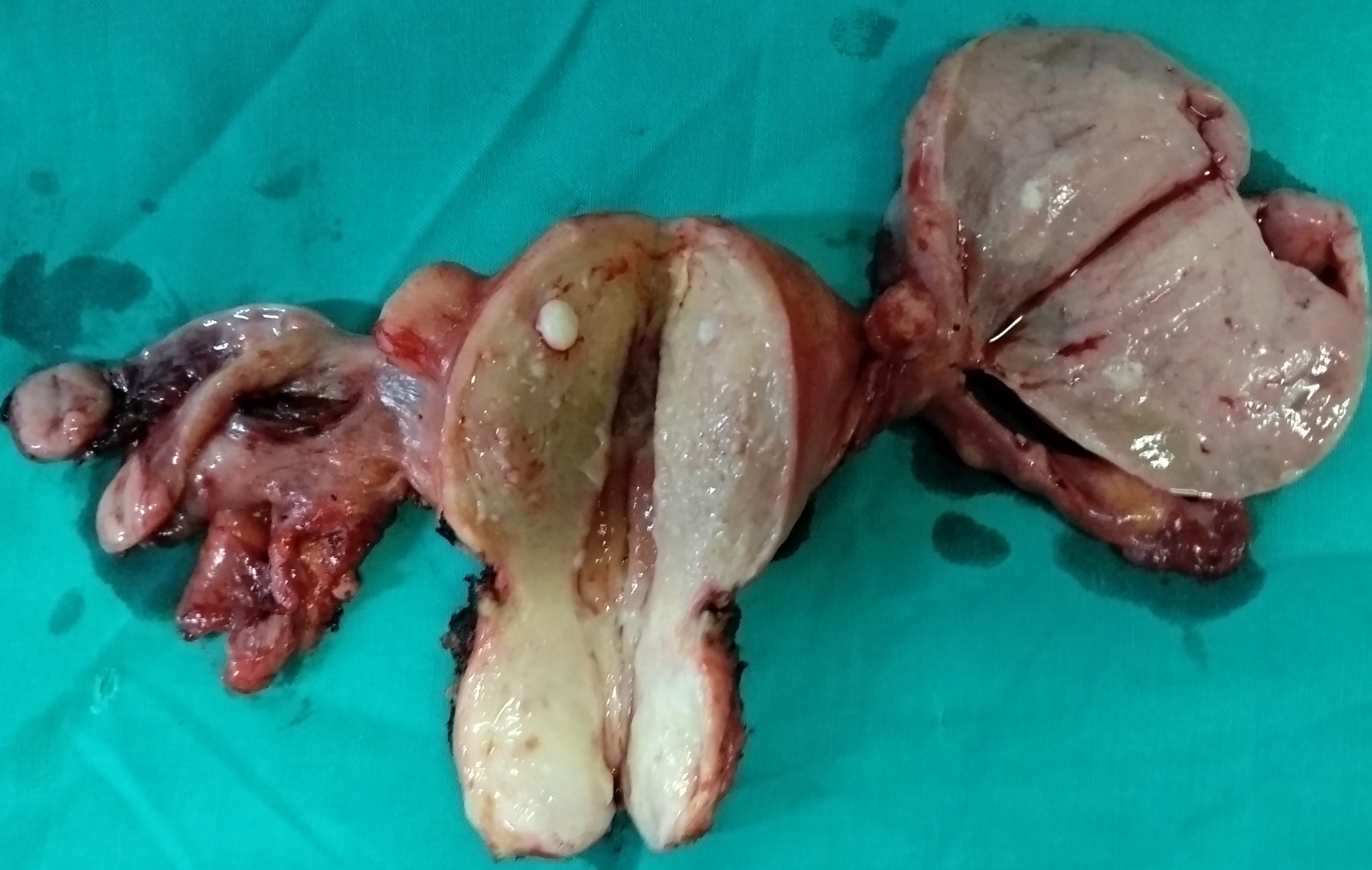 OVARIAN CARCINOMA