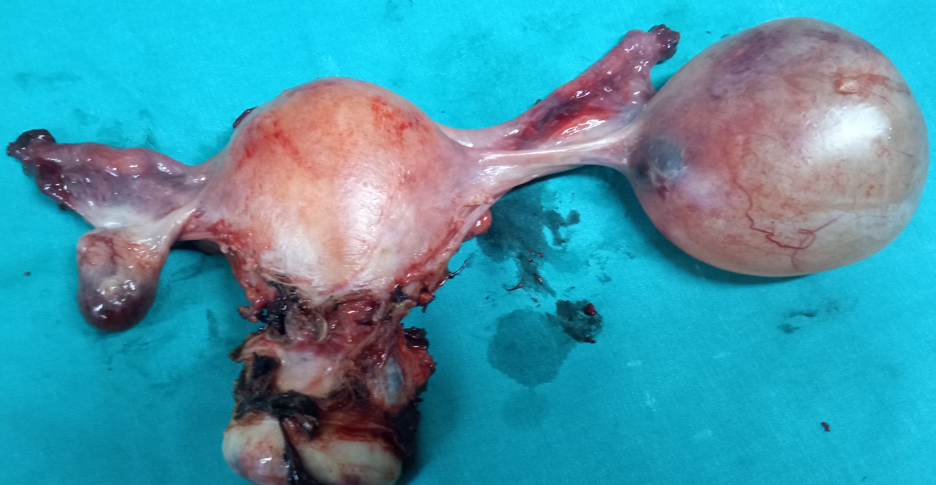TOTAL HYSTERECTOMY