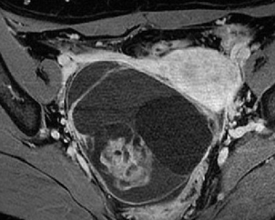 IMMATURE OVARIAN TERATOMA 