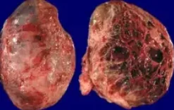IMMATURE TERATOMA