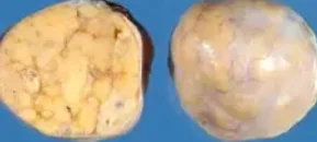 JUVENILE GRANULOSA CELL TUMOR