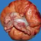 KRUKENBERG TUMOR