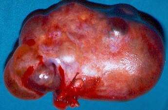 BENIGN OVARIAN CYSTADENOMA