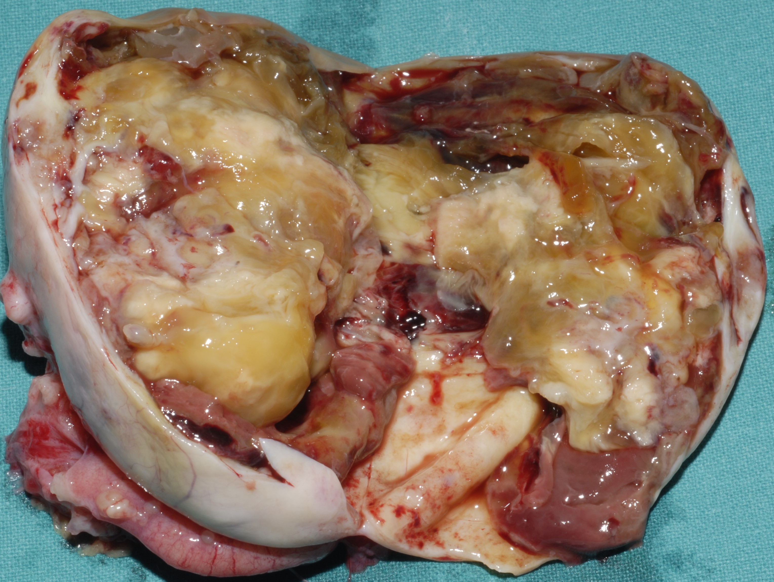 OVARIAN CARCINOMA