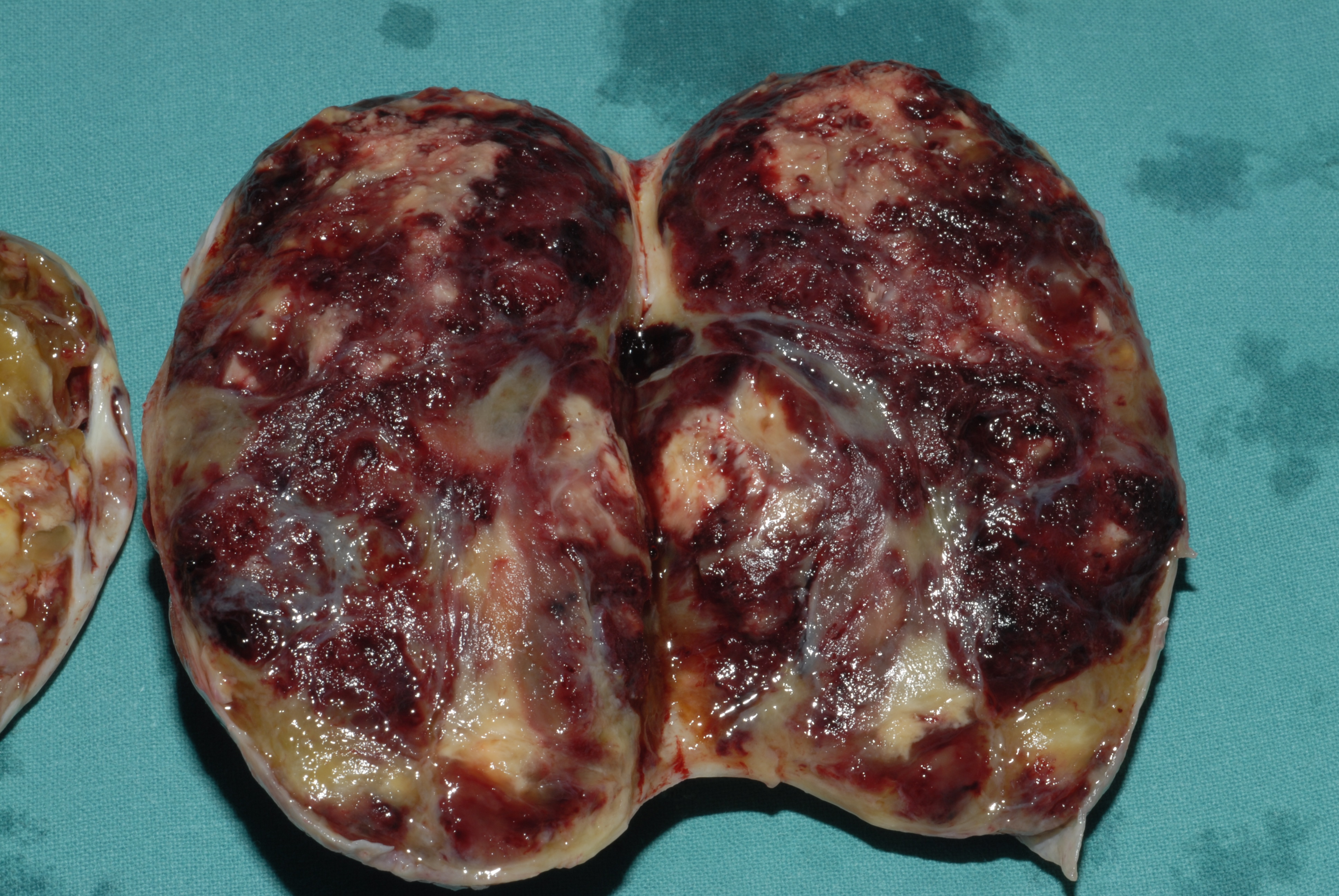 OVARIAN CARCINOMA