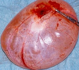 SEROUS OVARIAN CYSTADENOMA