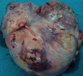 MIXED GERMCELL OVARIAN TUMOR