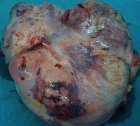 MIXED GERM CELL OVARIAN TUMOR