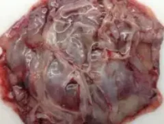 MUCINOUS CYSTADENOMA