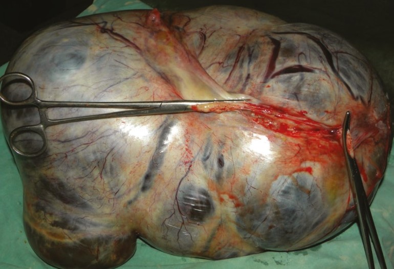 MUCINOUS OVARIAN CYSTADENOMA