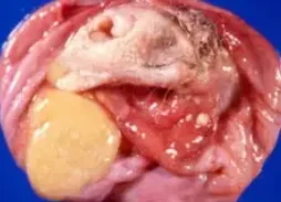 OVARIAN CARCINOID