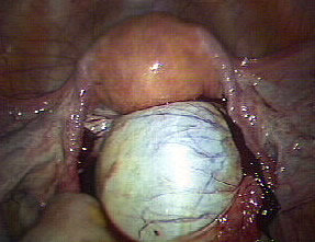 OVARIAN CYST