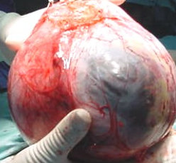 OVARIAN CYST