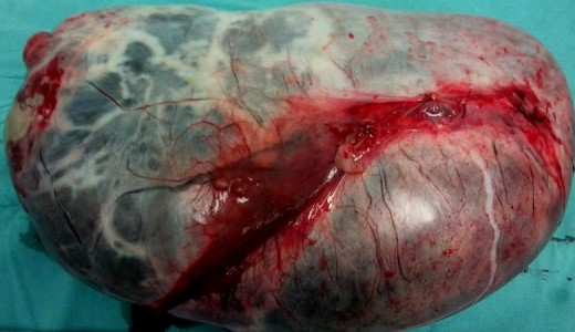 SEROUS CYSTEDENOMA
