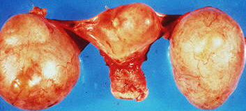 BILATERAL OVARIAN CYSTS