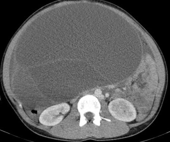 OVARIAN CYST