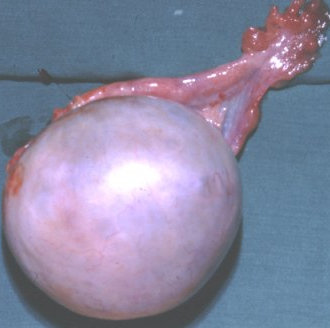 OVARIAN CYST
