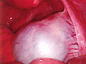 OVARIAN CYST