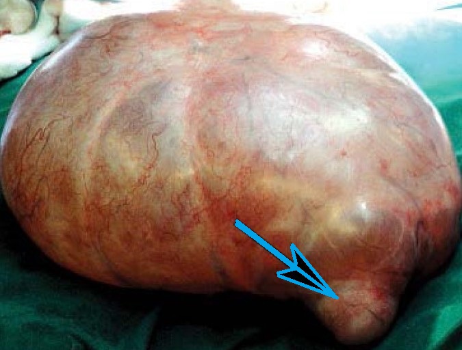 OVARIAN CYSTADENOMA