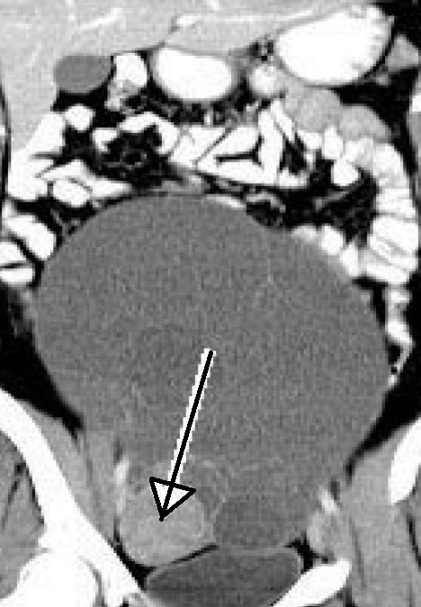 OVARIAN CYSTADENOMA