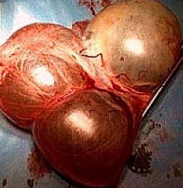 OVARIAN CYSTADENOMA