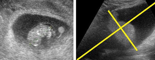 OVARIAN DERMOID CYST