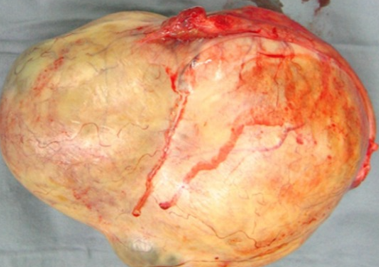 OVARIAN DERMOID CYST