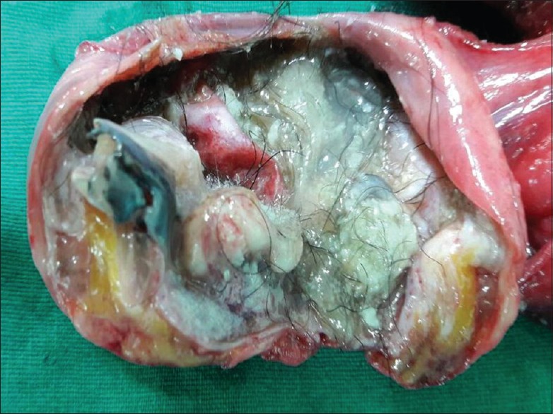 OVARIAN DERMOID CYST