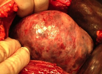 OVARIAN DERMOID CYST
