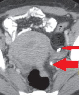 OVARIAN DERMOID CYST