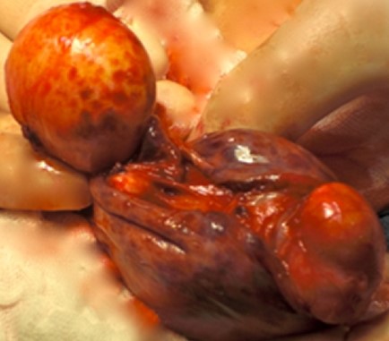 OVARIAN DERMOID CYST